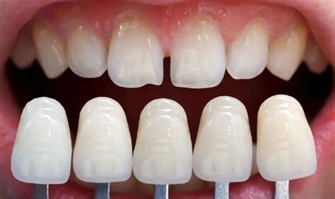 What Are Dental Veneers And How Do They Work