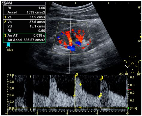 Kidney Ultrasound Findings