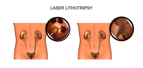 Ureteroscopy And Laser Lithotripsy Treatment Singapore Dr Fiona