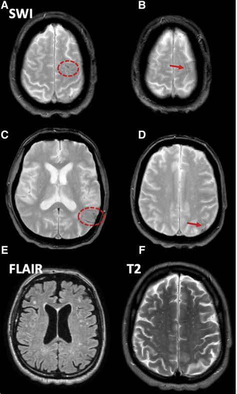 Cortical Superficial Siderosis And Transient Focal Neurological Episode