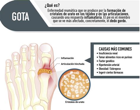 Gota Qué es causas síntomas tratamiento y consejos FisioOnline