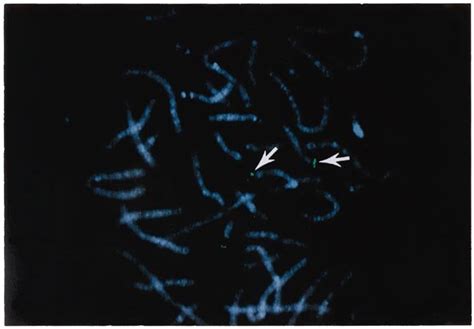 Chromosomal Localization Of The Human Yy Gene Metaphase Chromosomes