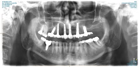 All on 4/all teeth replacement | Lifestyle Dental Studio