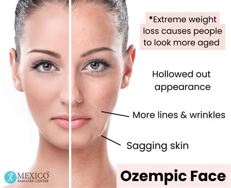 What Is Ozempic Face And How Can People Avoid It 58 Off