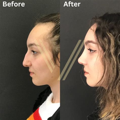 Nose Job Rhinoplasty In Istanbul Turkey Procedure Prices