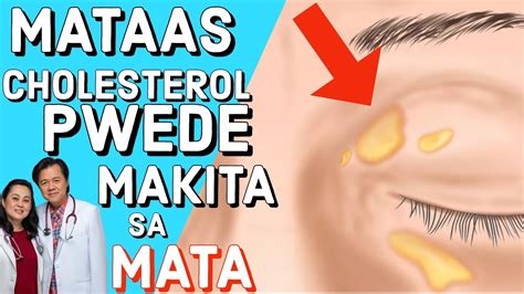 Mataas Na Cholesterol Puwede Makita Sa Mata Payo Ni Doc Willie Ong At Doc Liza Ong Youtube