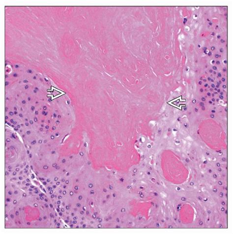 Proliferating Pilar Tricholemmal Cyst Tumor Basicmedical Key