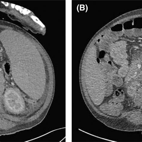 Axial Iv Contrast‐enhanced Ct Image Through The Abdomen A