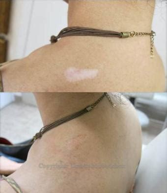 Skin Colored Tattoos To Cover Scars Lovetoknow