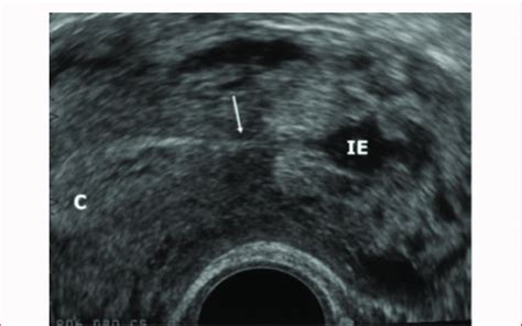 Ultrasound Findings Of Interstitial Ectopic Pregnancy Ie