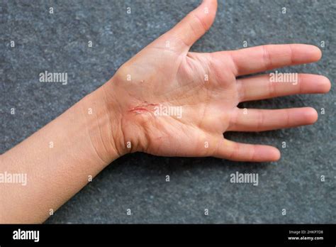 Close up palm of a injured hand with a bloody wound Stock Photo - Alamy