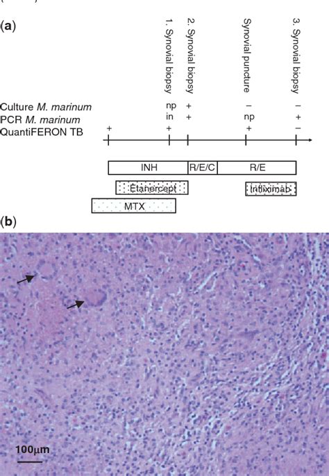 Figure 1 From Osteopontin In The Development Of Systemic Sclerosis