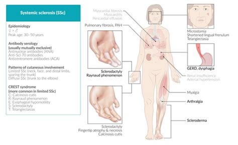 Systemic sclerosis Flashcards | Quizlet