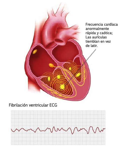 Arritmias Ventriculares Boston Scientific