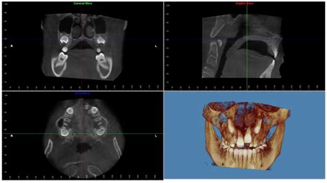 Jcm Free Full Text Comparing Airway Analysis In Two Time Points