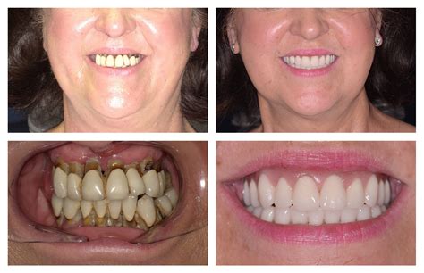 Denture Stabilisation With Implants In Surrey Mulberry Dental