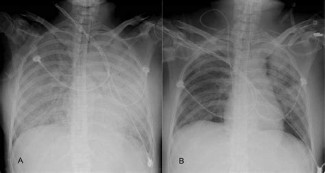 A Diffuse Bilateral Pulmonary Infiltration Indicating Acute Pulmonary