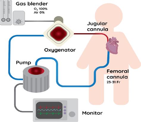 Vv Ecmo Circuit