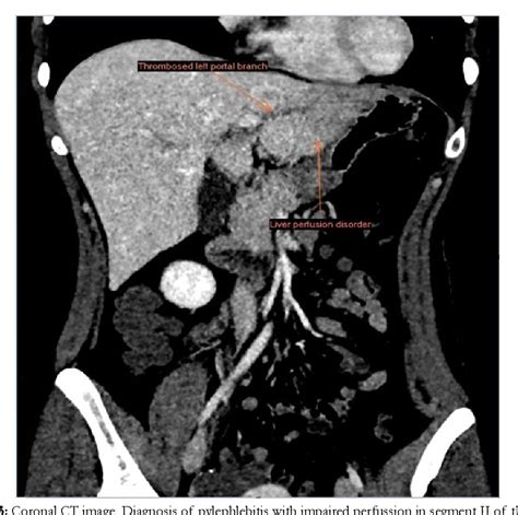 Figure 3 From Infective Suppurative Thrombosis In The Left Portal Vein