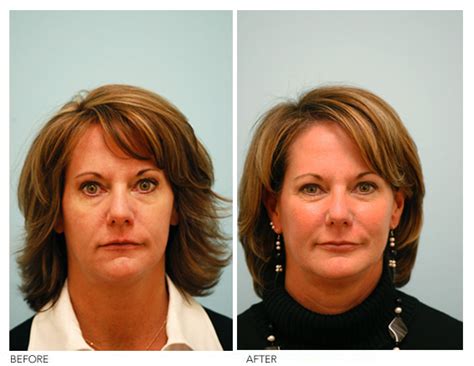 Asymmetrical Face Correction