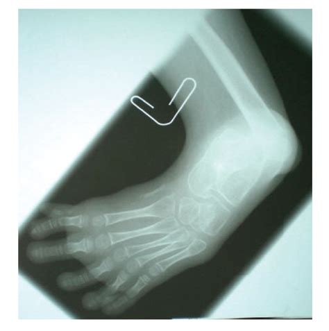 The First Metatarsal Bone Is Smaller And Longer As Resulting From