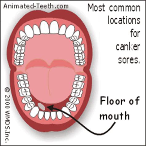 Canker Sore Soft Palate