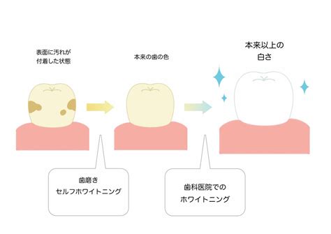 歯を白くしたい人必見！歯を白くする方法を目的別に紹介！【セルフ・歯科医】｜wakanote