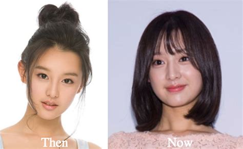 Kim Ji Won Plastic Surgery Before and After Photos - Latest Plastic ...