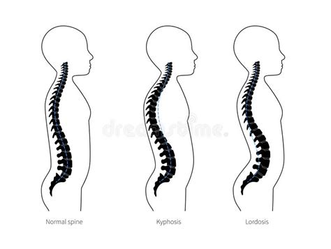 Icona Silhouette Lineare Scoliosi Curvatura Spinale Cifosi Lordosi