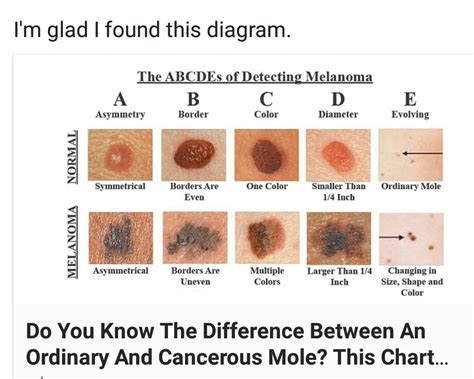 Mole ID | Cancerous moles, Mole, Skin moles