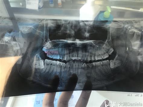 整牙日记02：拔第一颗智齿费用405元 哔哩哔哩