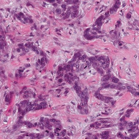 2 Moderately Differentiated Squamous Cell Carcinoma Showing Vesicular