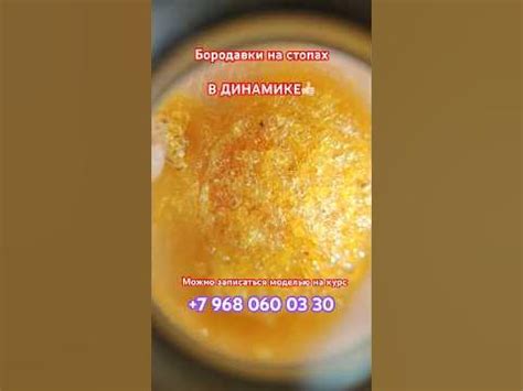 Как убрать бородавку на ноге /бородавка на ноге/ бородавки # ...