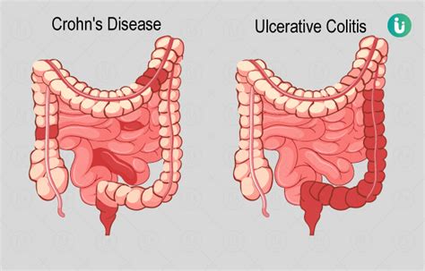 Inflammatory Bowel Disease Symptoms Causes Treatment Medicine