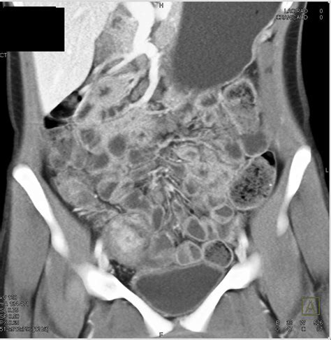 Crohn S Disease Of The Small Bowel With Ct Enterography Small Bowel