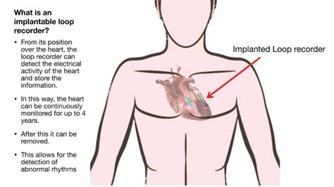 Loop Recorder Implantation - Bayside Heart