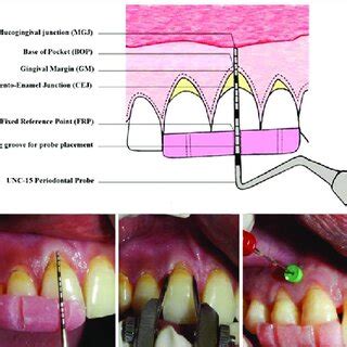 A C Mucogingival Tunnel Extending From 21 To13 SCTG Being Inserted