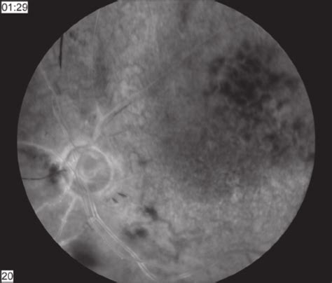 Radiation Retinopathy And Choroidal Melanoma Photo Courtesy Of Dr Download Scientific Diagram