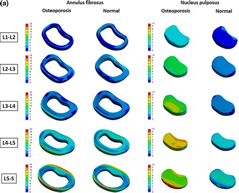 A Von Mises Stress Distribution On The Intervertebral Disc In