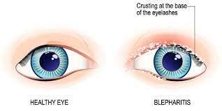 Blepharitis - 247homeopathy