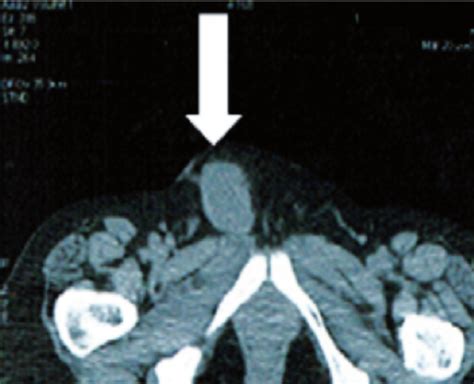 Computed Axial Tomography Of Proximal Type Epitheliod Sarcoma PES In