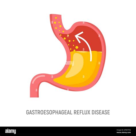 Gastroesophageal Reflux Disease Stomach Gerd Heartburn Esophagus Medical Illustration Stock