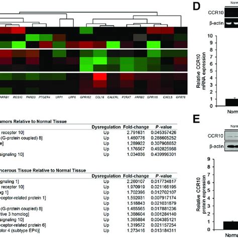 Human Hepatocarcinogenesis Associated With Inflammation A Macrophagic