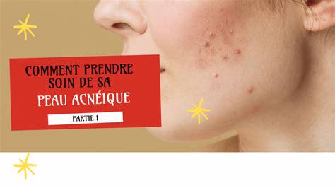 Comment Prendre Soin De Sa Peau Acneique Partie 1 Karila Cosmetics