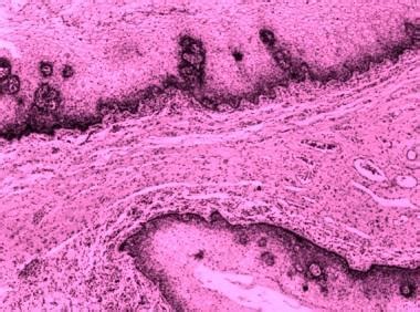 Histopathology Of Hymen Grey White Soft Tissue Bit Measuring Cm