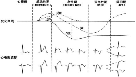 10分钟快速掌握急性心梗的心电图判读