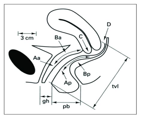 Points And Landmarks For Pop Q System Examination Aa Point A Download Scientific Diagram