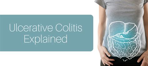 Understanding Ulcerative Colitis Dr Eduan Deetlefs Cape Town