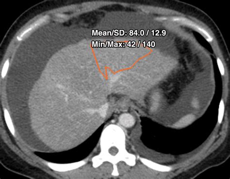 Quantitative Color Mapping Of The Arterial Enhancement Fraction In