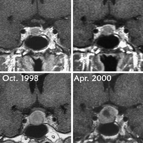 The Magnetic Resonance Images Demonstrate Regrowth Of A Non Functioning